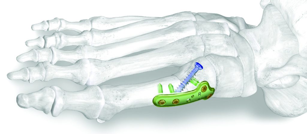 Premier dispositifs de fixation osseuse complètement résorbable